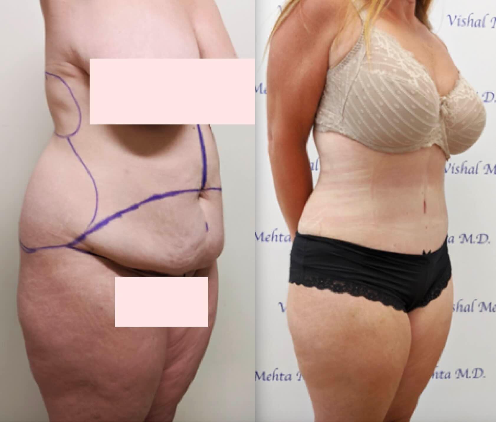 Before & after results of abdominoplasty, tummy tuck, panniculectomy performed by Dr. Vishal Mehta, top bariatric Surgeon serving Central NJ, Princeton, Montgomery, and surrounding areas.