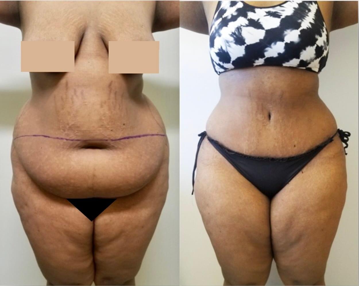 Before & after results of awake liposuction, lipo-sculpting performed by Dr. Vishal Mehta, top Liposuction Surgeon, Central NJ