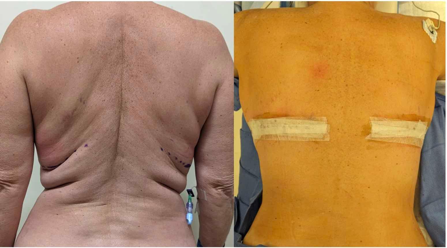 Before & after results of bra-line back lift, performed by Dr. Vishal Mehta, top Surgeon serving Central NJ, Princeton, Montgomery, and surrounding areas.