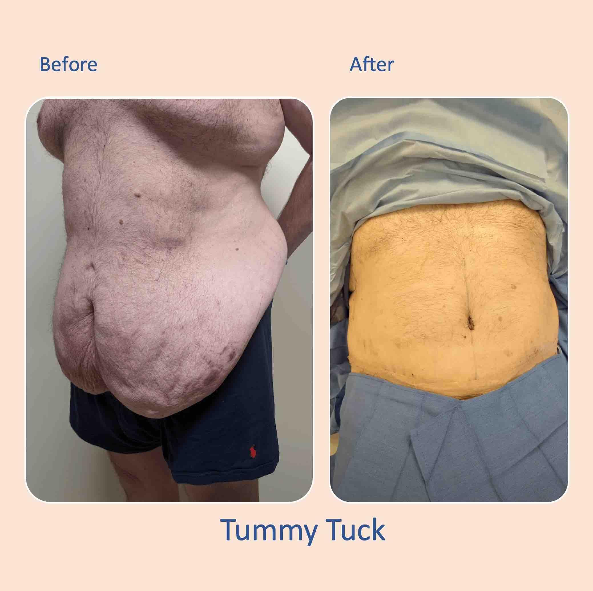Before & after results of male, men, abdominoplasty, tummy tuck, panniculectomy performed by Dr. Vishal Mehta, top bariatric Surgeon serving Central NJ, Princeton, Montgomery, and surrounding areas.
