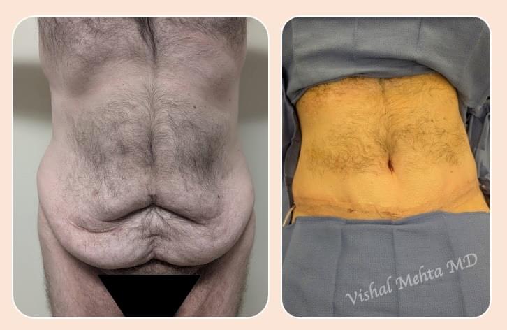 Before & after results of male, men, abdominoplasty, tummy tuck, panniculectomy performed by Dr. Vishal Mehta, top bariatric Surgeon serving Central NJ, Princeton, Montgomery, and surrounding areas.