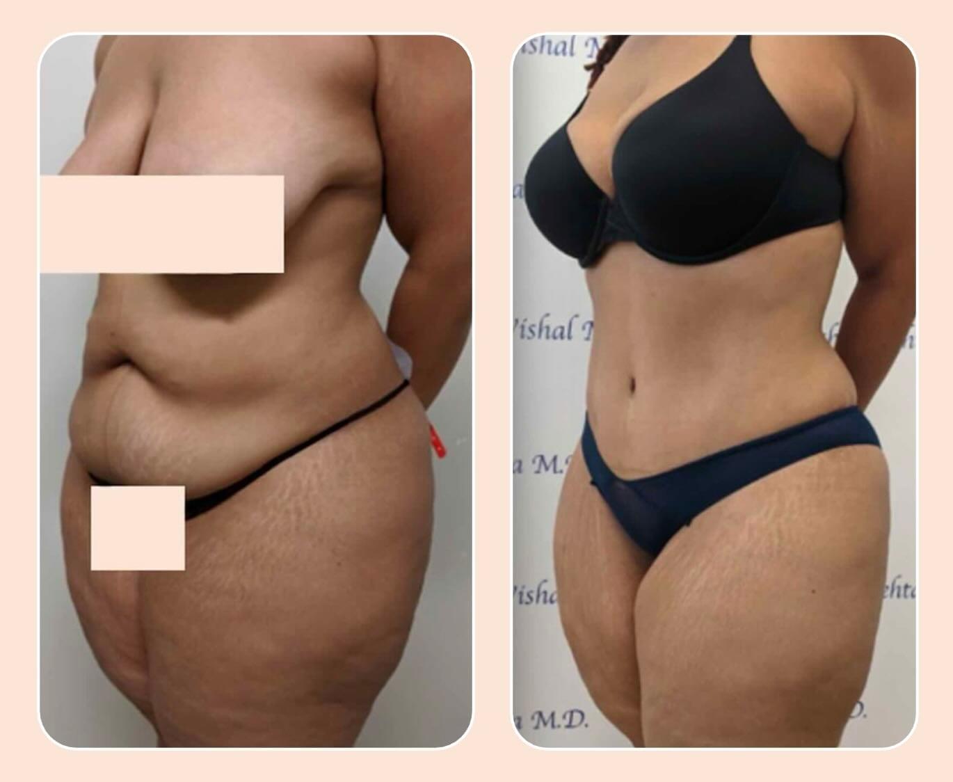 Before & after results of tummy tuck and liposuction, lipo-sculpting performed by Dr. Vishal Mehta, top Liposuction Surgeon serving Central NJ, Princeton, Montgomery, NJ and surrounding areas.