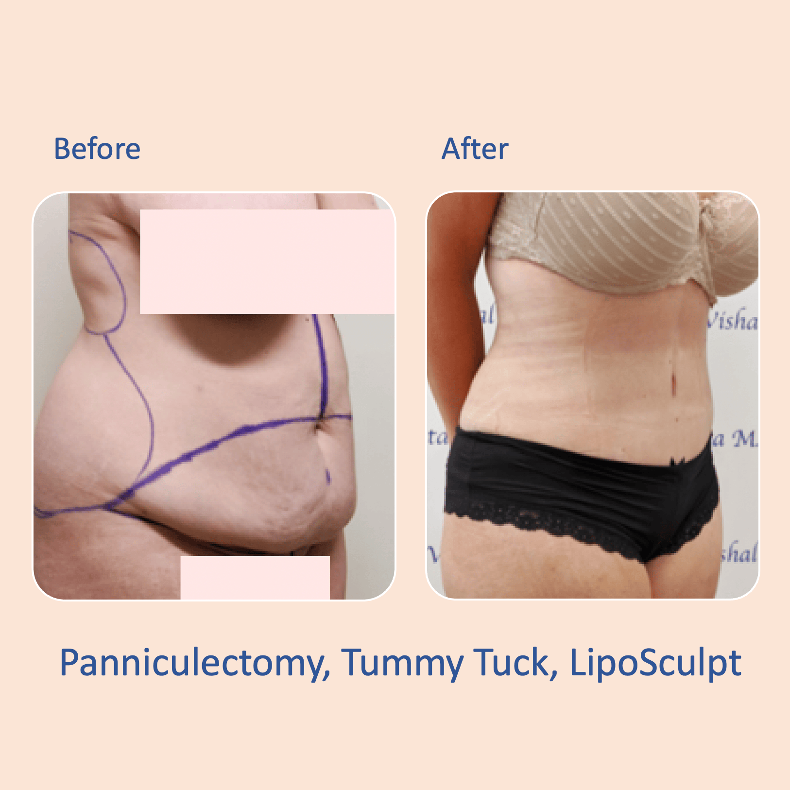 Before & after results of abdominoplasty, tummy tuck, panniculectomy performed by Dr. Vishal Mehta, top bariatric Surgeon serving Central NJ, Princeton, Montgomery, and surrounding areas.