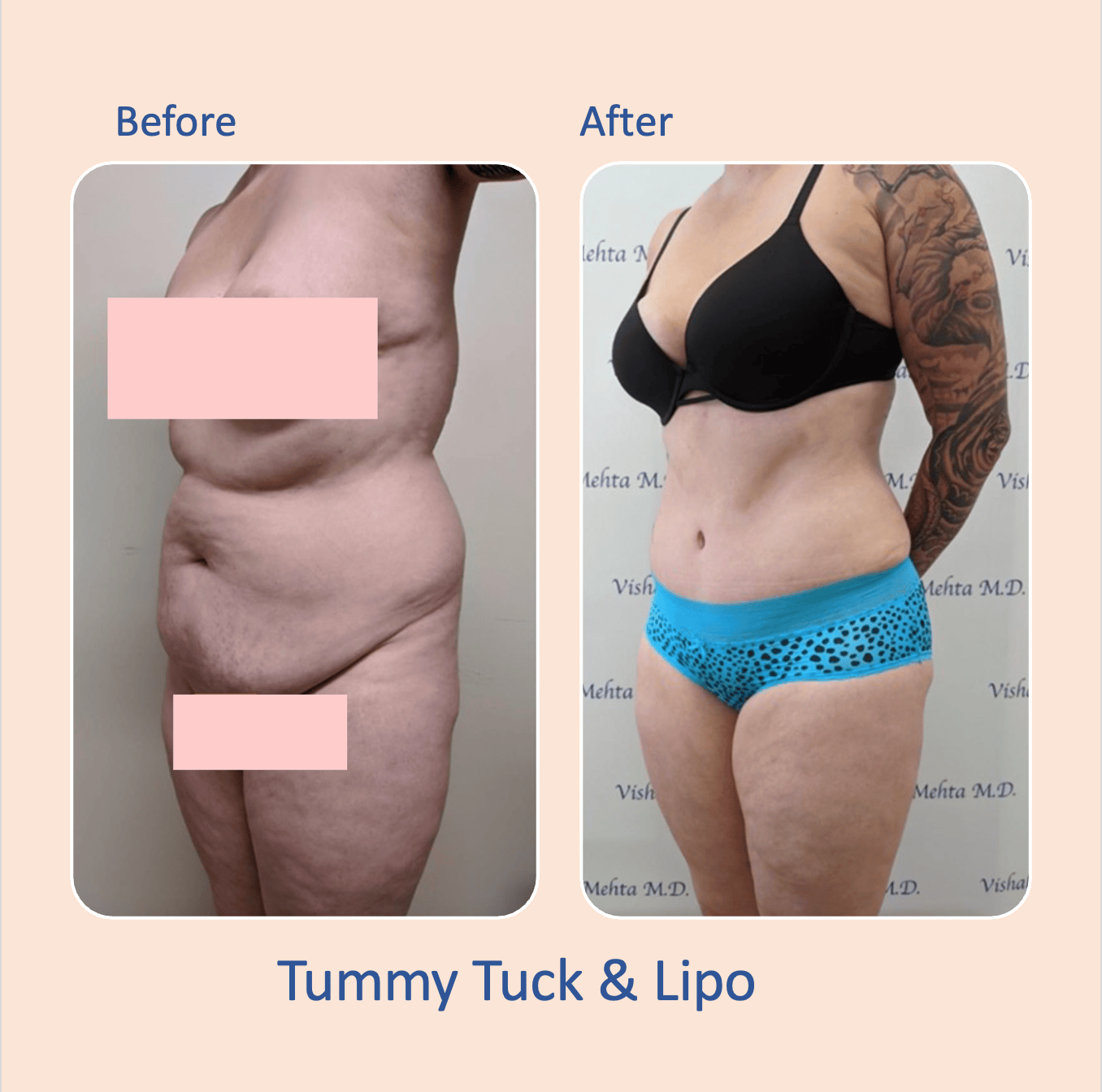 Before & after results of bariatric surgery, gastric sleeve, weight loss surgery, performed by Dr. Vishal Mehta, top bariatric Surgeon serving Central NJ, Princeton, Montgomery, and surrounding areas.