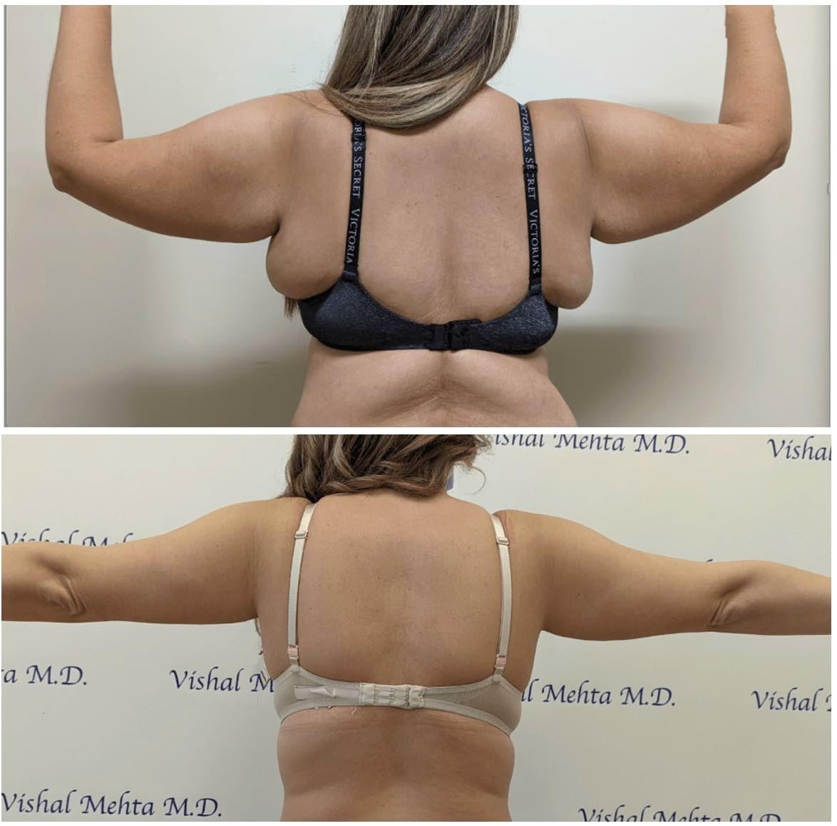 Before & after results of bra-line back lift, performed by Dr. Vishal Mehta, top Surgeon serving Central NJ, Princeton, Montgomery, and surrounding areas.