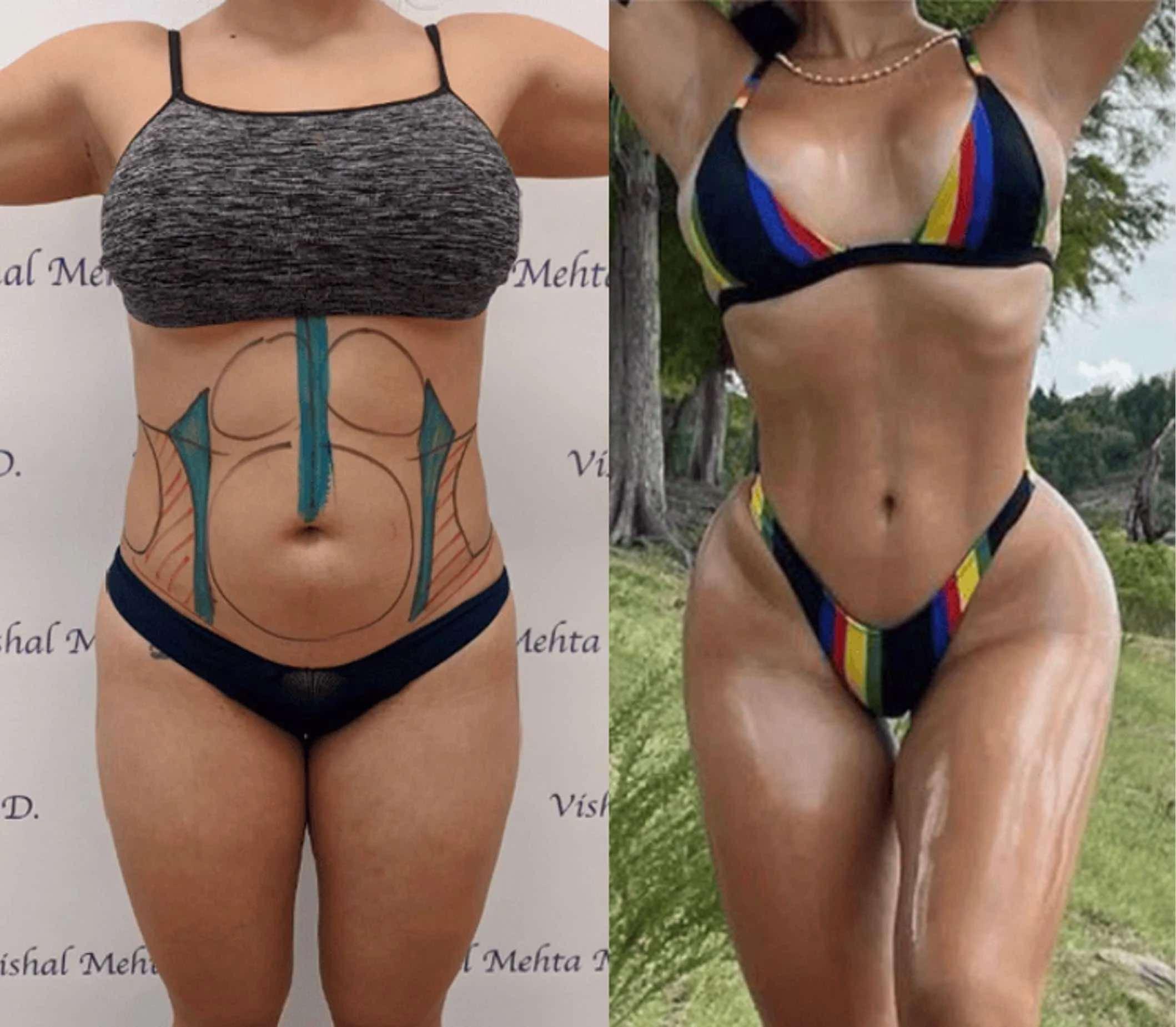 Before & after results of bariatric surgery, gastric sleeve, weight loss surgery, performed by Dr. Vishal Mehta, top bariatric Surgeon serving Central NJ, Princeton, Montgomery, and surrounding areas.