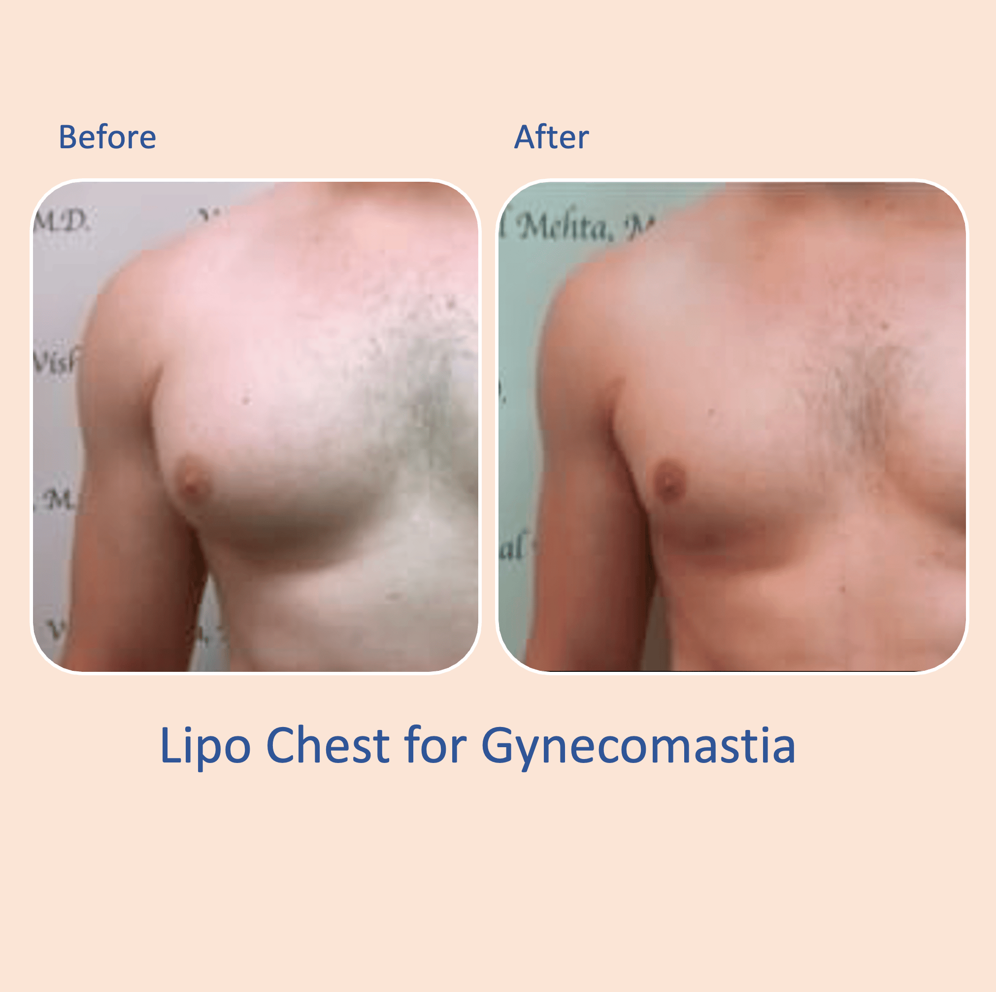 Before & after results of awake liposuction, lipo-sculpting gynecomastia, male chest, performed by Dr. Vishal Mehta, top Liposuction Surgeon, Central NJ
