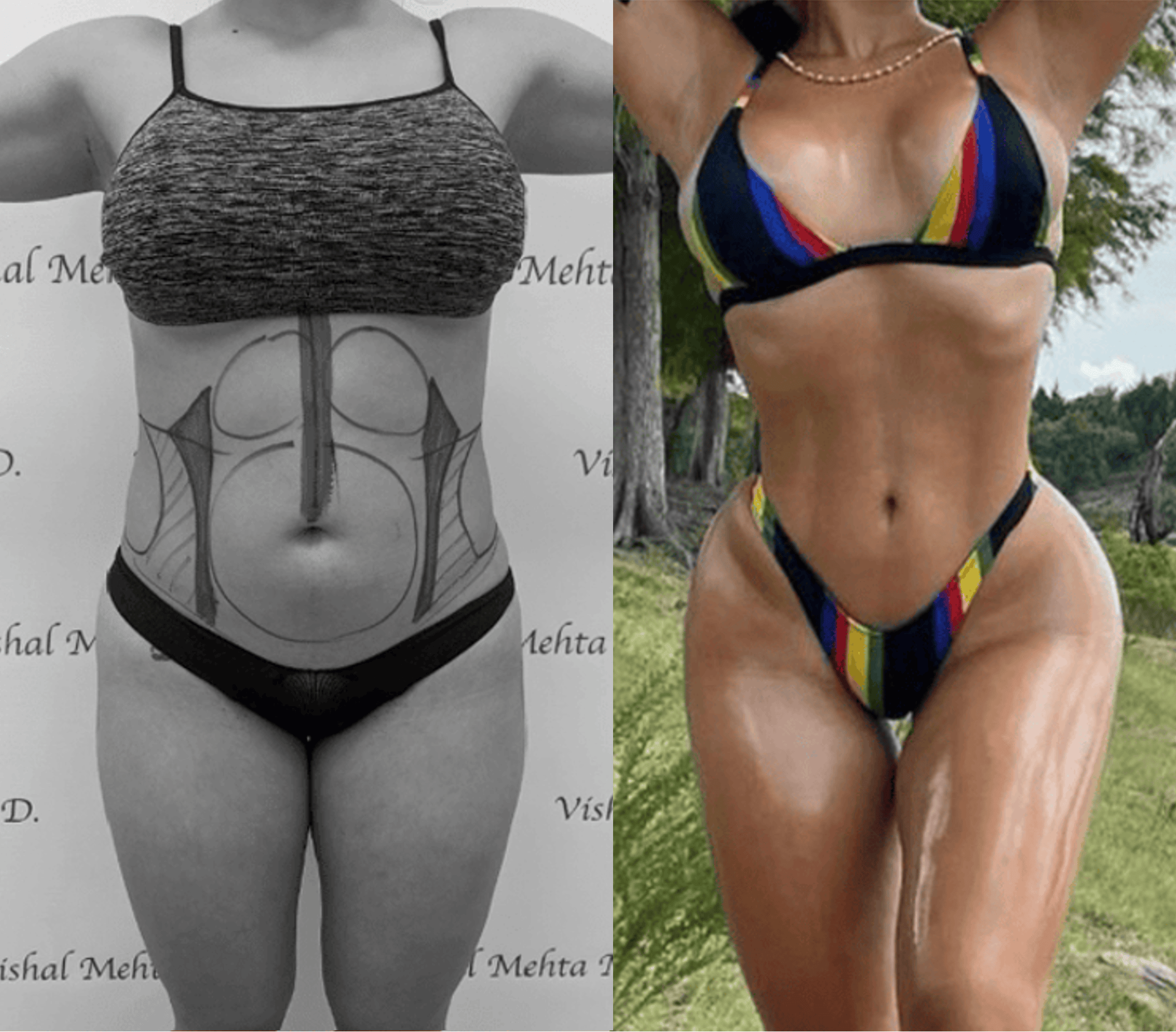 Before & after results of bariatric surgery, gastric sleeve, weight loss surgery, performed by Dr. Vishal Mehta, top bariatric Surgeon serving Central NJ, Princeton, Montgomery, and surrounding areas.
