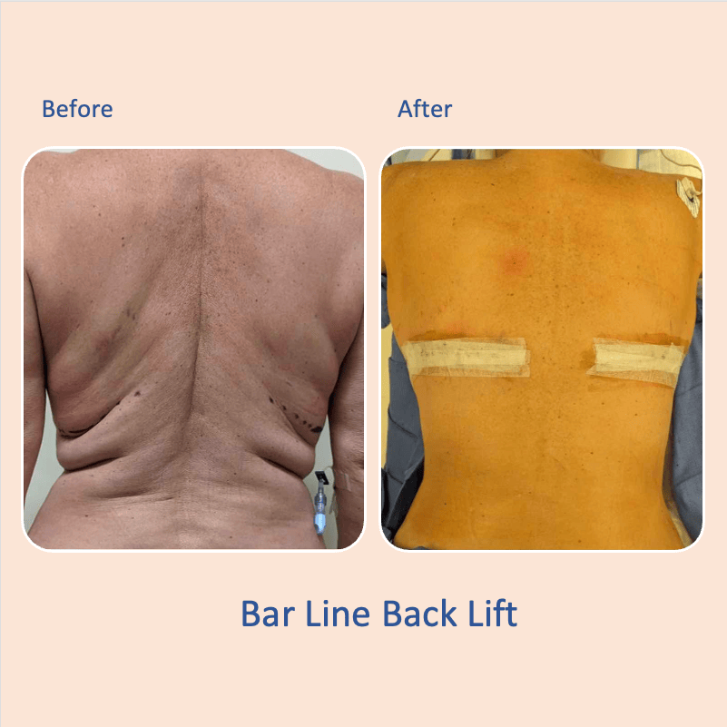 Before & after results of bra-line back lift, performed by Dr. Vishal Mehta, top Surgeon serving Central NJ, Princeton, Montgomery, and surrounding areas.