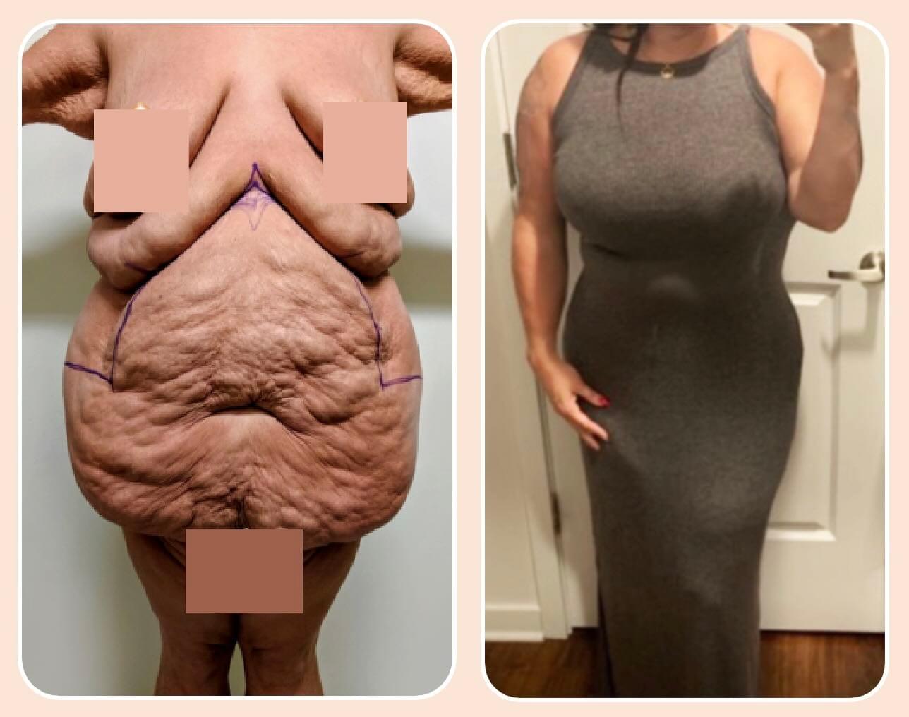 Before & after results of male, men, abdominoplasty, tummy tuck, panniculectomy performed by Dr. Vishal Mehta, top bariatric Surgeon serving Central NJ, Princeton, Montgomery, and surrounding areas.