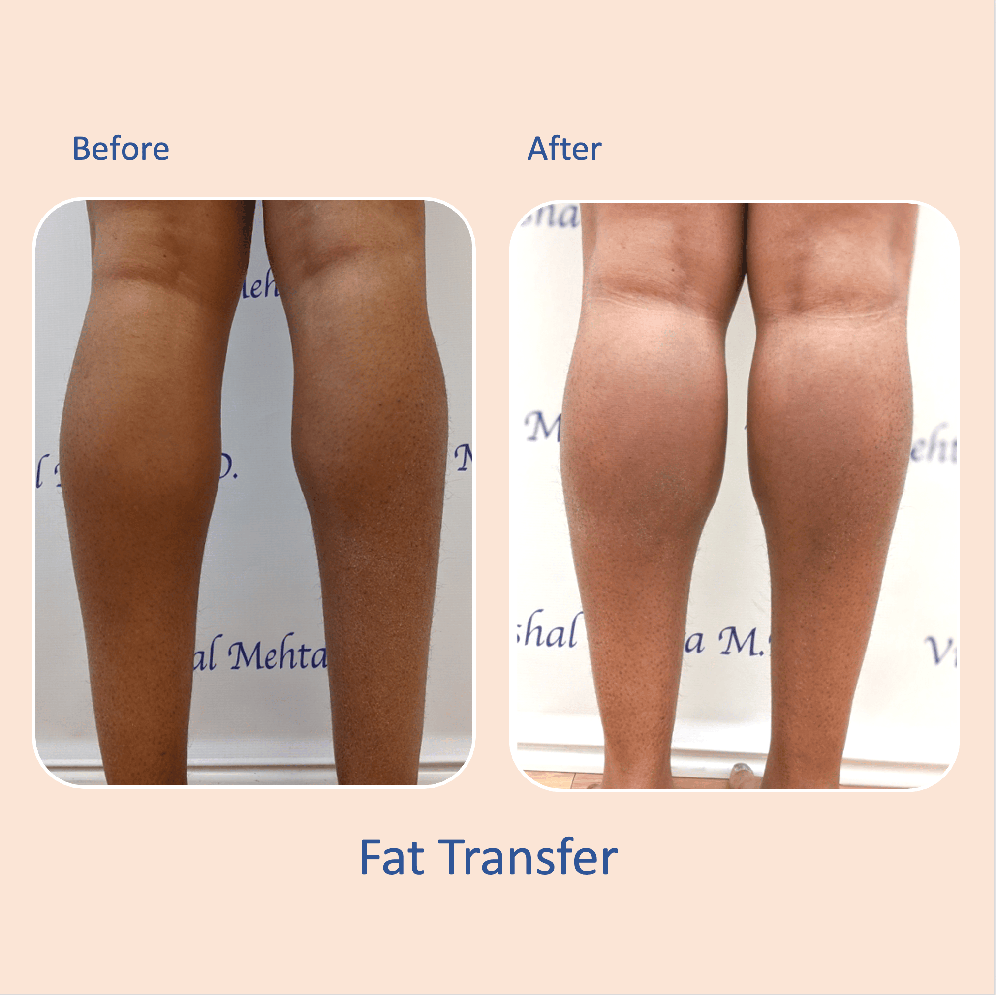 Before & after results of awake liposuction, lipo-sculpting and fat transfer to calves performed by Dr. Vishal Mehta, top Liposuction Surgeon, Central NJ