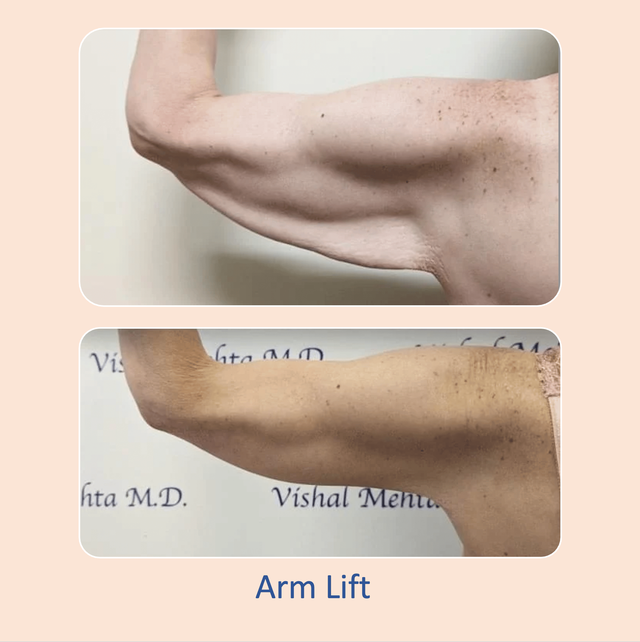 Before & after results of arm lift performed by Dr. Vishal Mehta, top arm lift Surgeon serving Central NJ, Princeton, Montgomery, and surrounding areas.