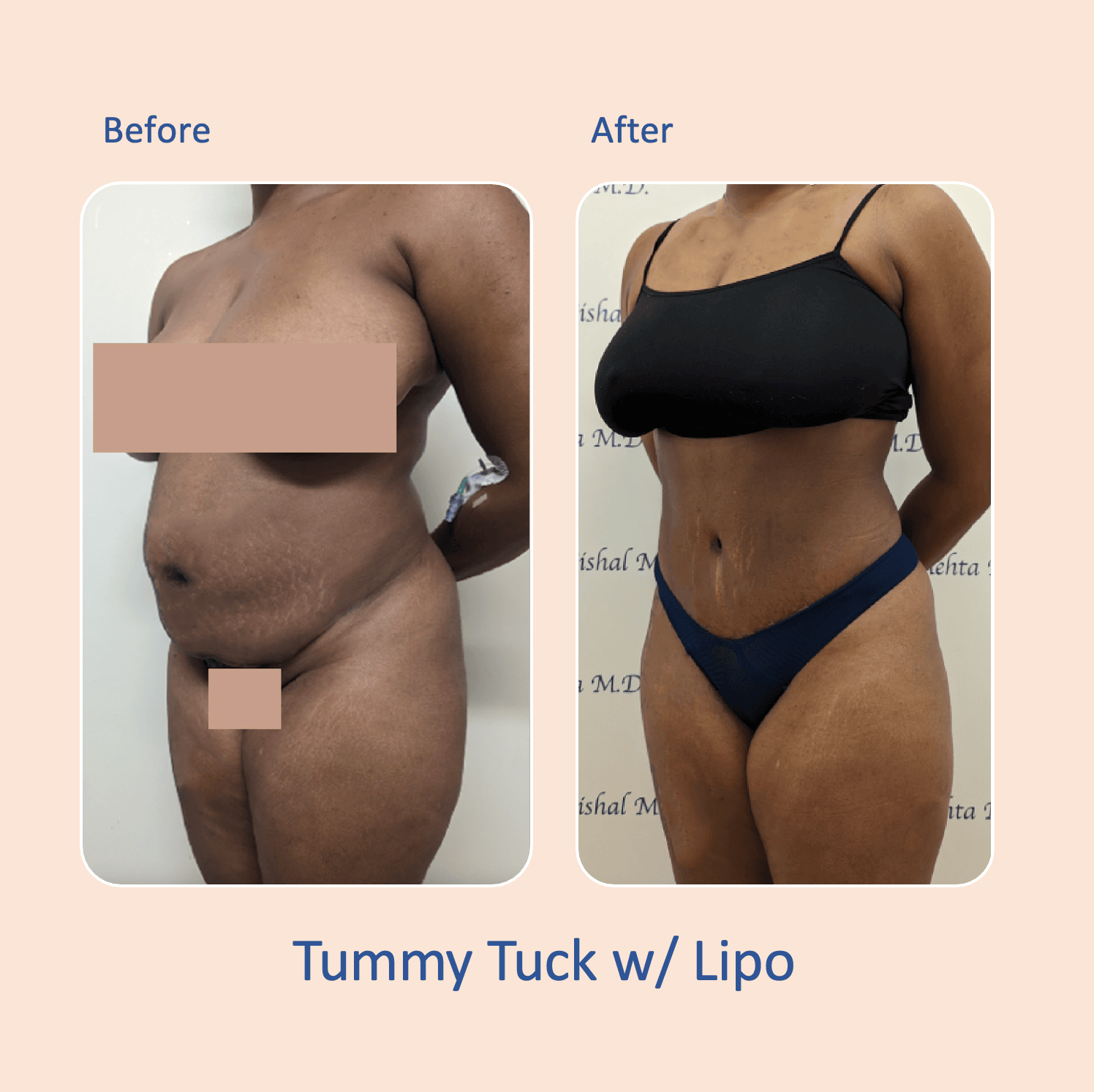 Before & after results of awake mini-tummy tuck and liposuction, lipo-sculpting performed by Dr. Vishal Mehta, top Liposuction Surgeon, Central NJ