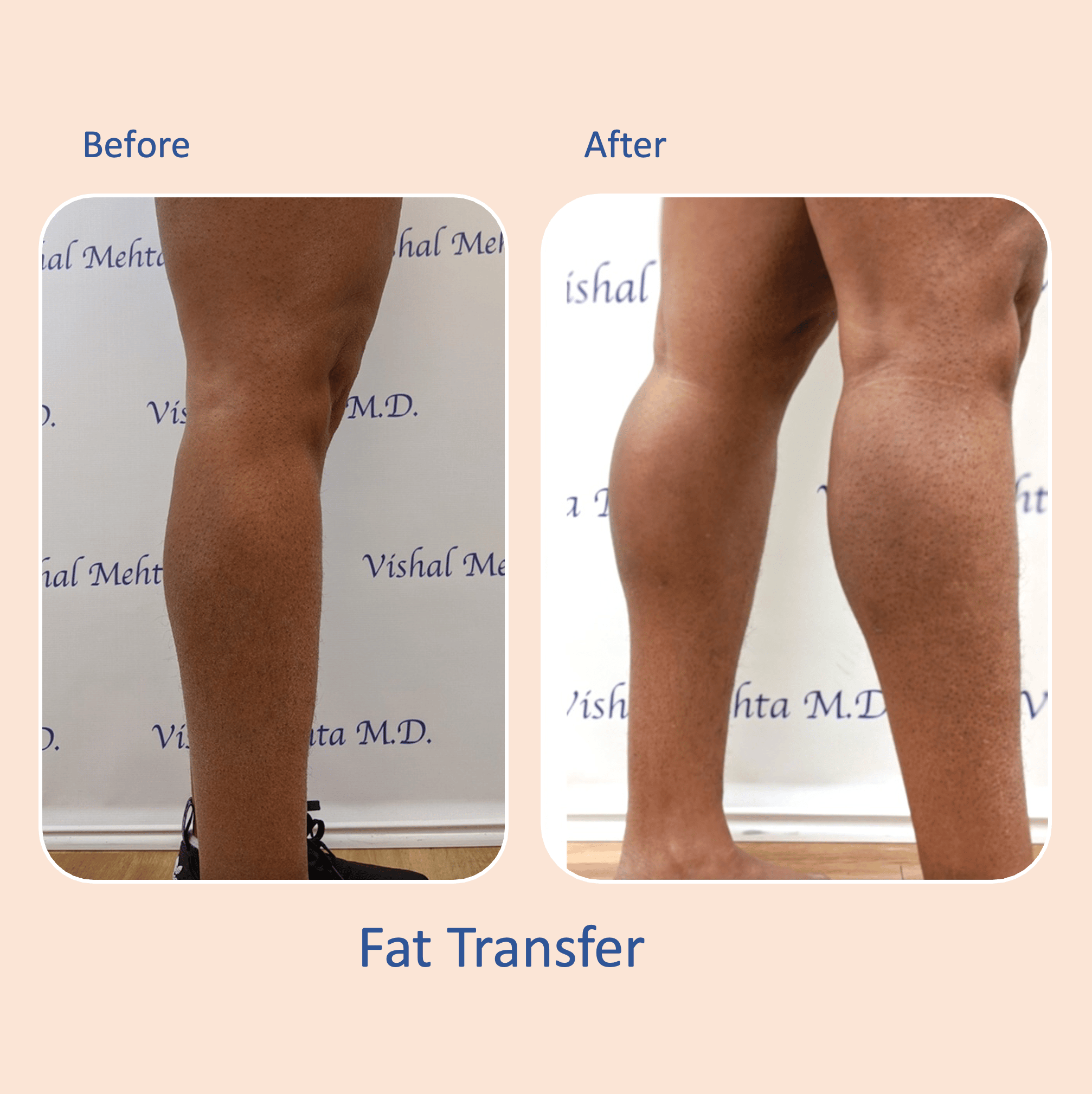Before & after results of awake liposuction, lipo-sculpting and fat transfer to calves performed by Dr. Vishal Mehta, top Liposuction Surgeon, Central NJ