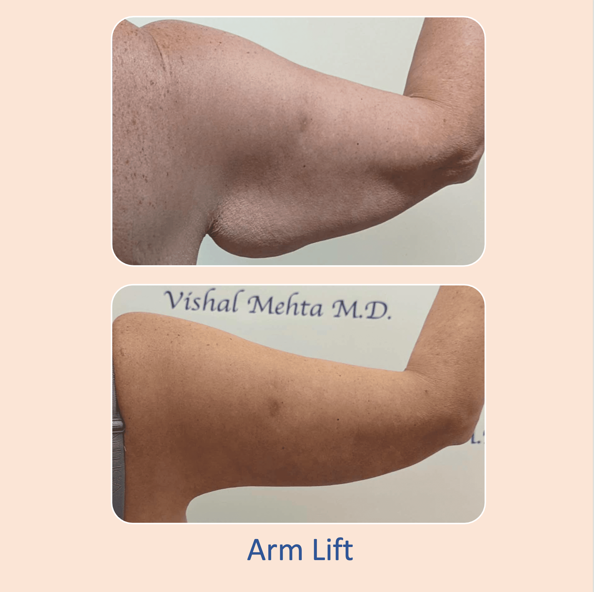 Before & after results of arm lift performed by Dr. Vishal Mehta, top arm lift Surgeon serving Central NJ, Princeton, Montgomery, and surrounding areas.
