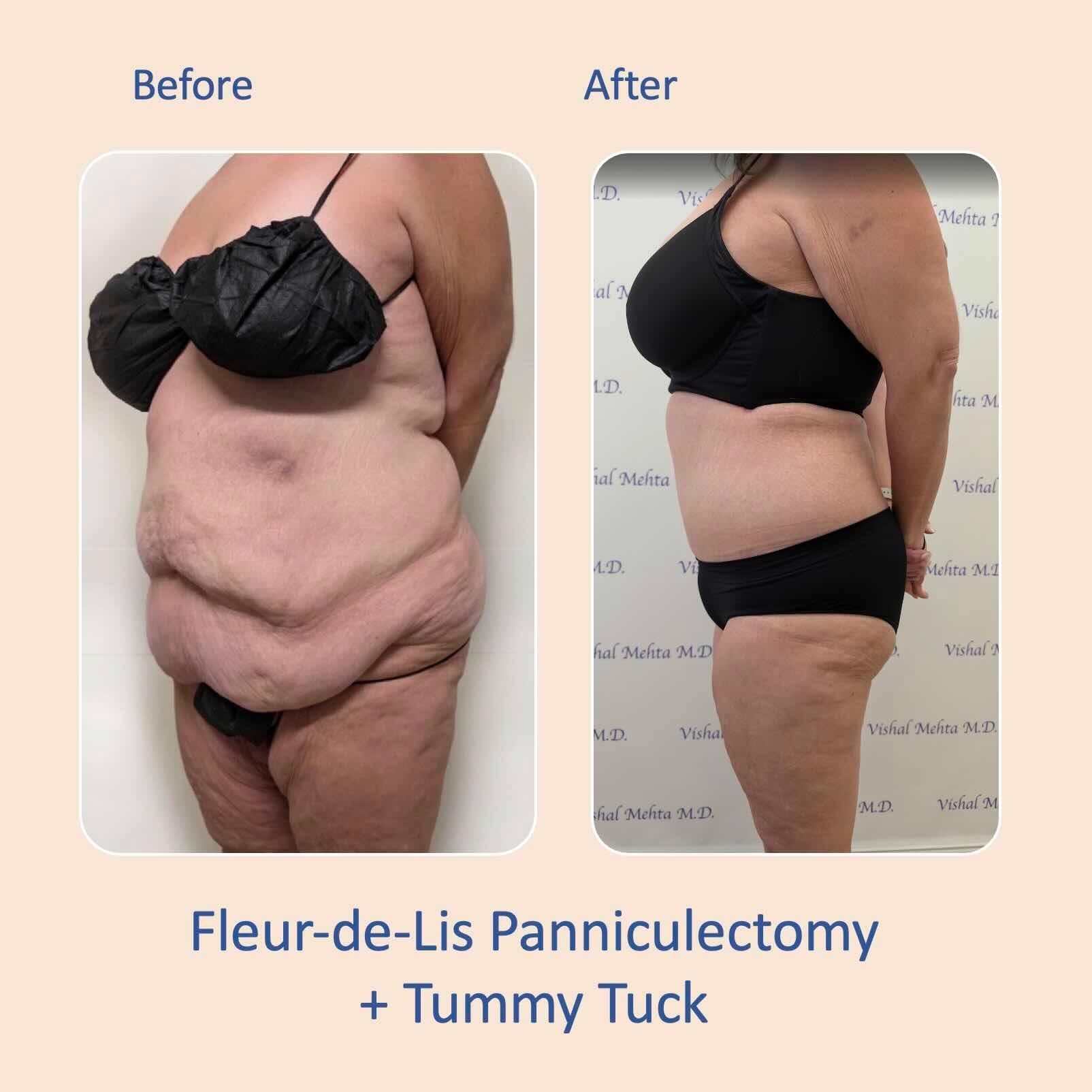 Before & after results of abdominoplasty, tummy tuck, panniculectomy performed by Dr. Vishal Mehta, top bariatric Surgeon serving Central NJ, Princeton, Montgomery, and surrounding areas.