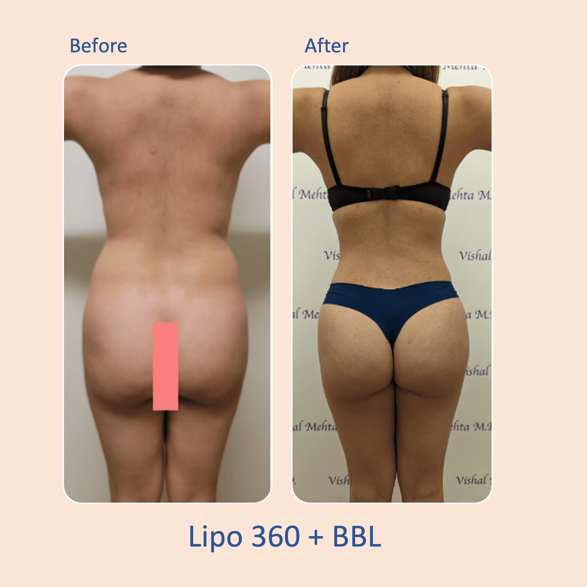 Before & after results of awake liposuction, lipo-sculpting and fat transfer to buttocks, Brazilian Butt Lift, BBL performed by top Liposuction Surgeon, Central NJ