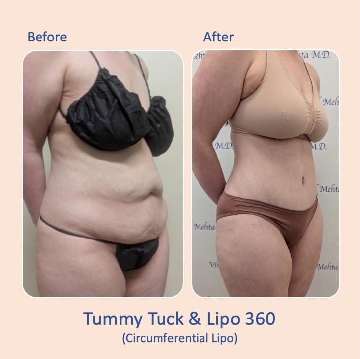 Before & after results of tummy tuck and liposuction, lipo-sculpting performed by Dr. Vishal Mehta, top Liposuction Surgeon serving Central NJ, Princeton, Montgomery, NJ and surrounding areas.