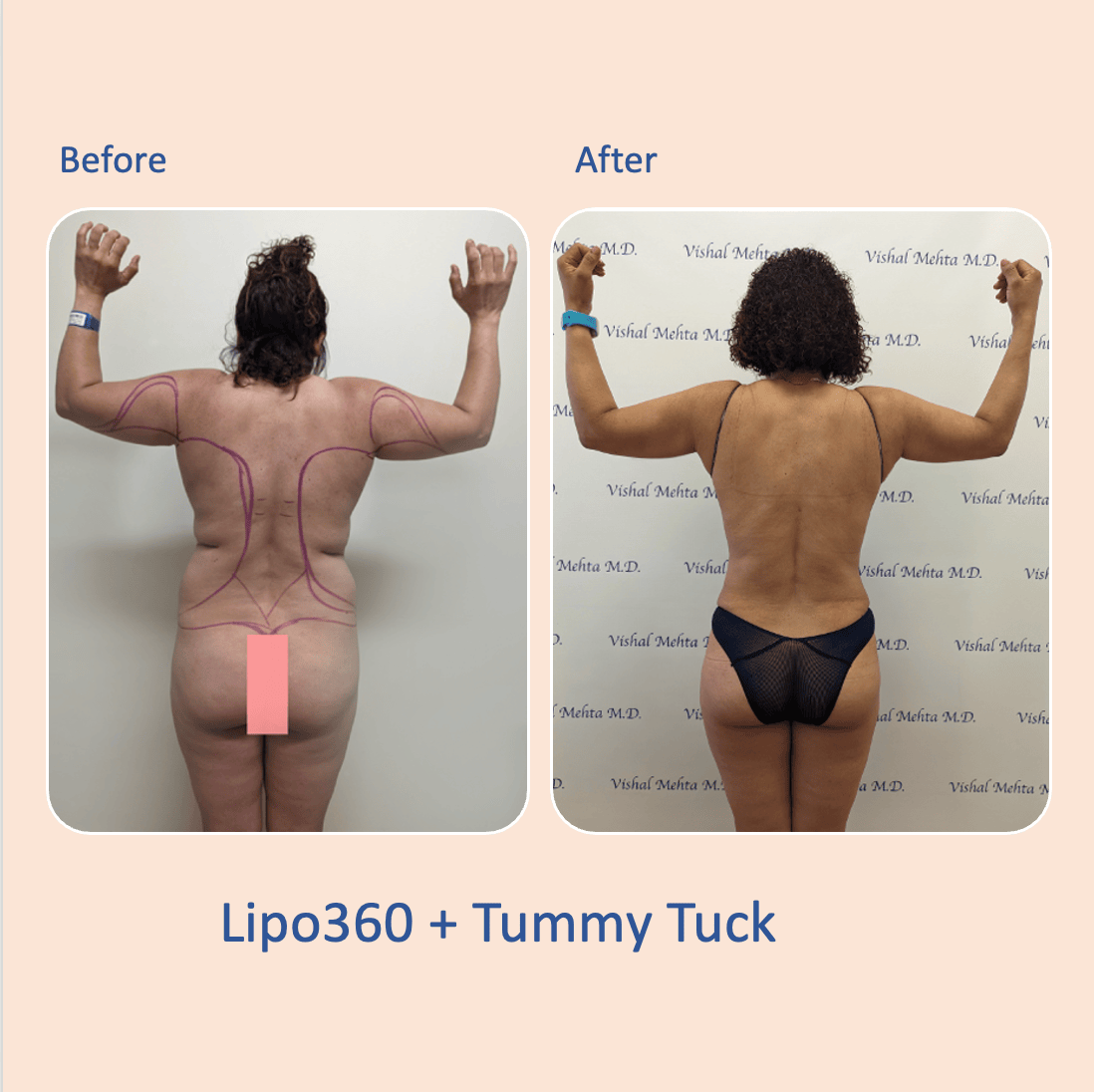 Before & after results of awake liposuction, lipo-sculpting performed by Dr. Vishal Mehta, top Liposuction Surgeon, Central NJ
