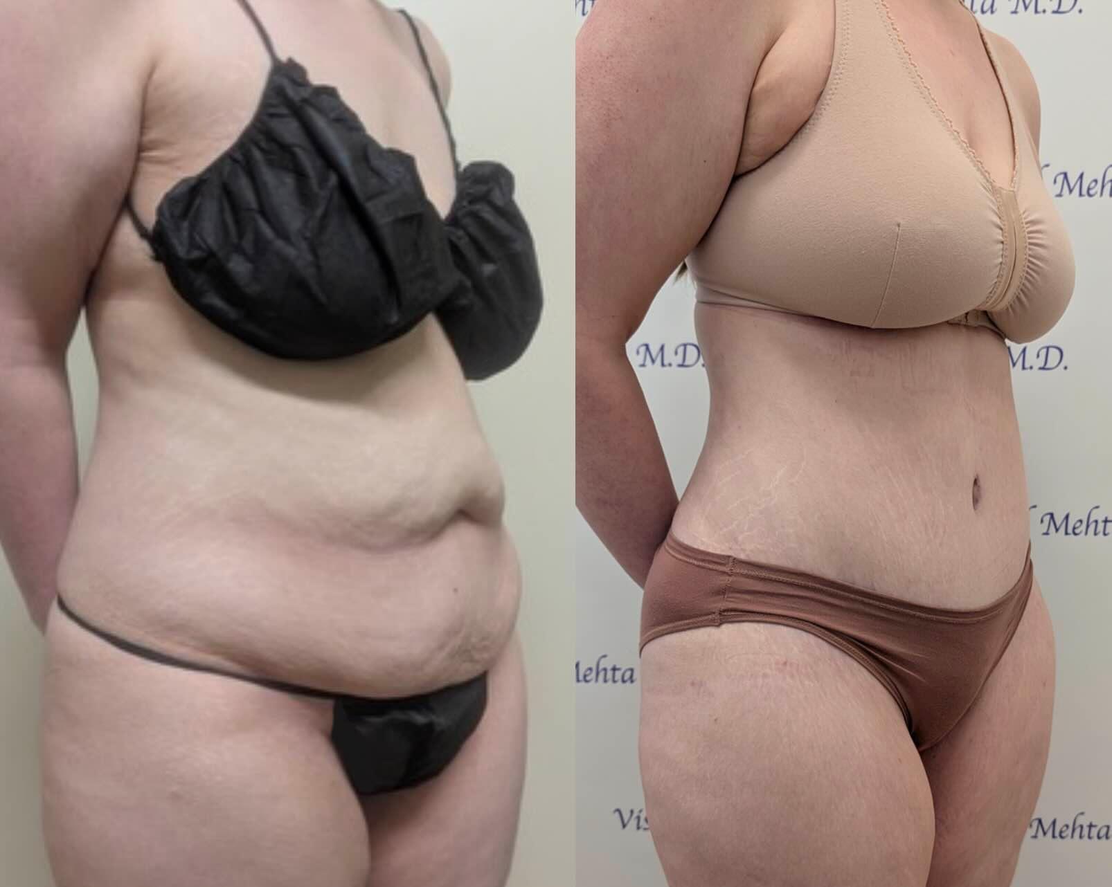 Before & after results of awake liposuction, lipo-sculpting performed by Dr. Vishal Mehta, top Liposuction Surgeon, Central NJ