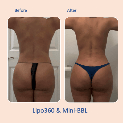 Before & after results of awake liposuction, lipo-sculpting and fat transfer to buttocks, Brazilian Butt Lift, BBL performed by top Liposuction Surgeon, Central NJ