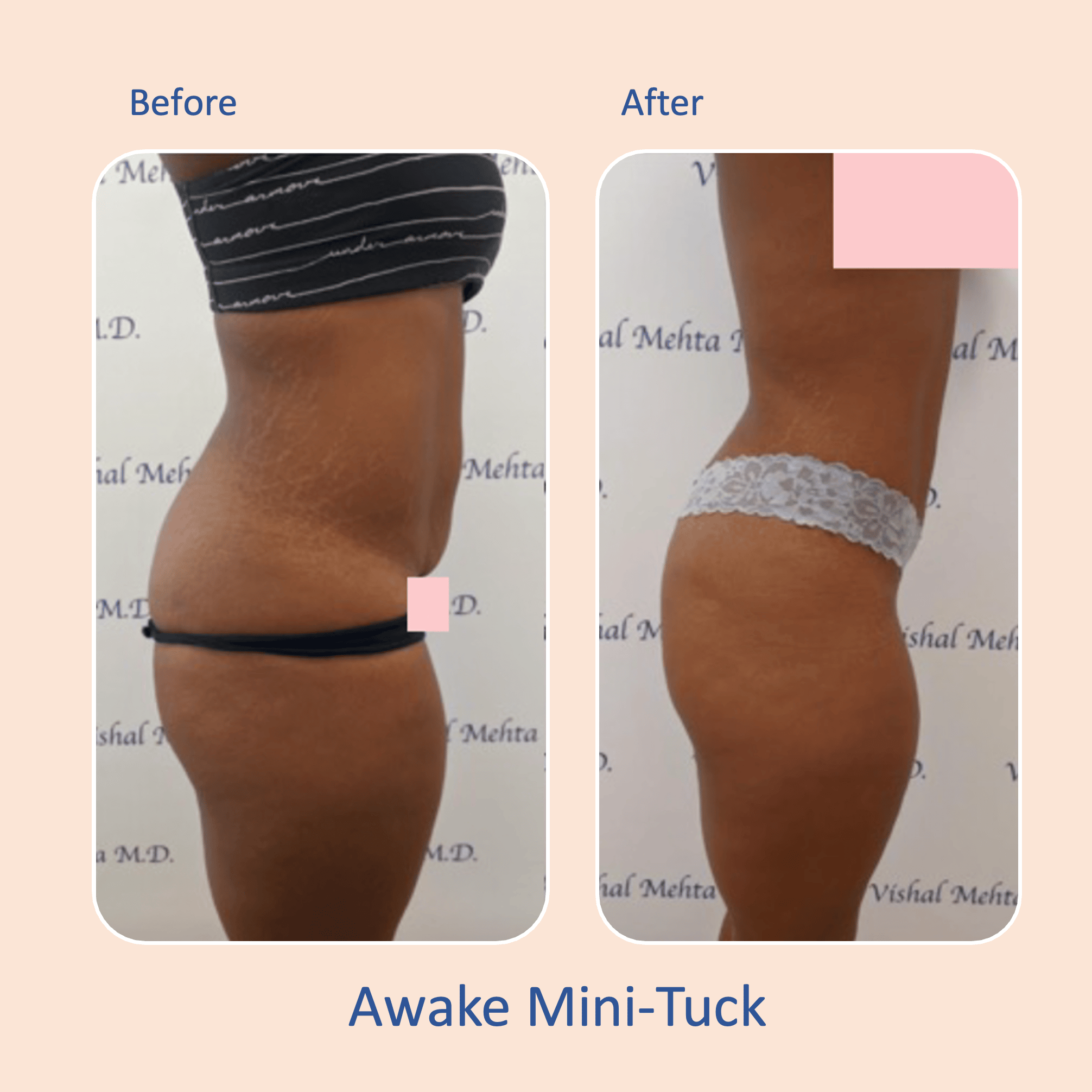 Before & after results of awake mini-tummy tuck and liposuction, lipo-sculpting performed by Dr. Vishal Mehta, top Liposuction Surgeon serving Central NJ, Princeton, Montgomery, and surrounding areas.