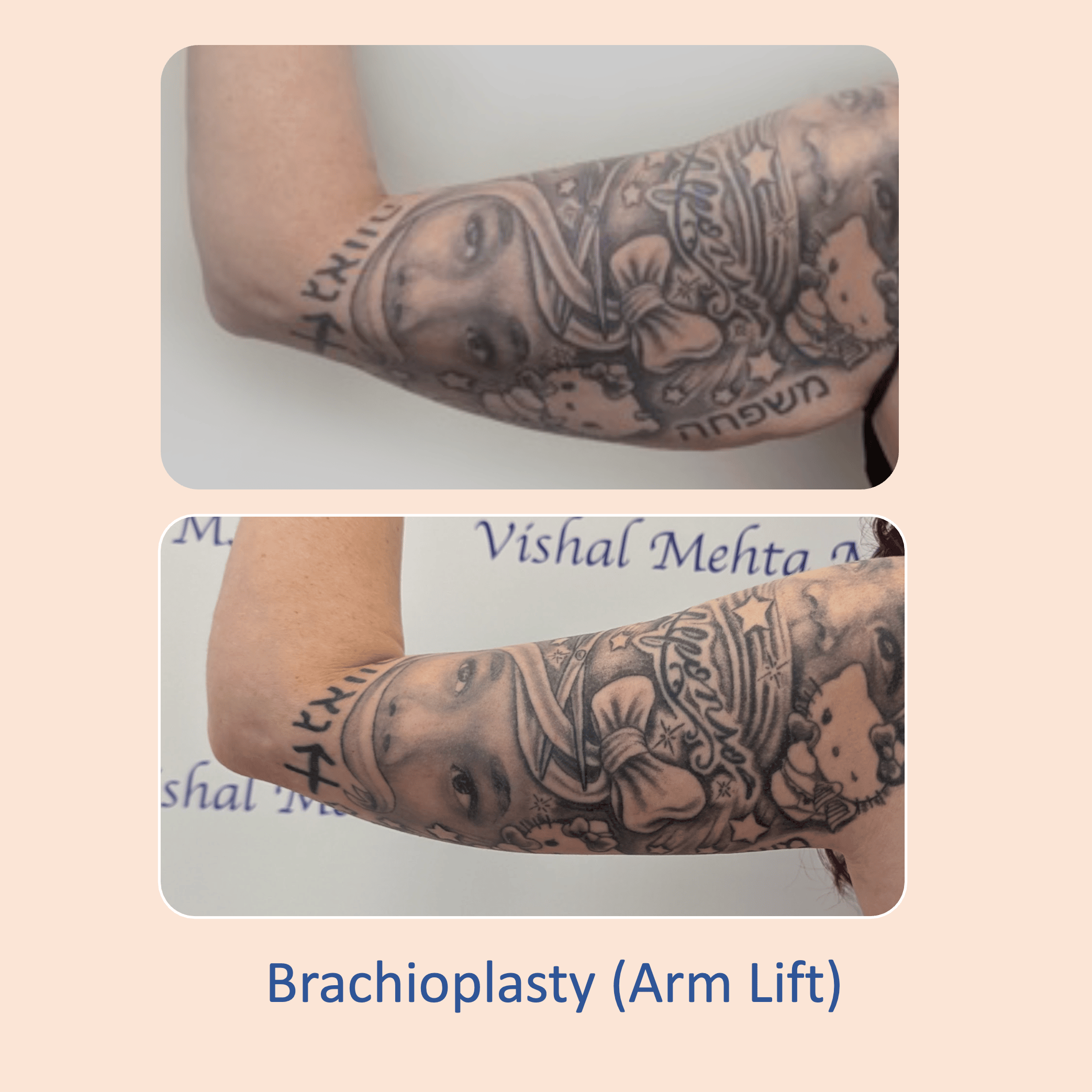 Before & after results of arm lift performed by Dr. Vishal Mehta, top arm lift Surgeon serving Central NJ, Princeton, Montgomery, and surrounding areas.