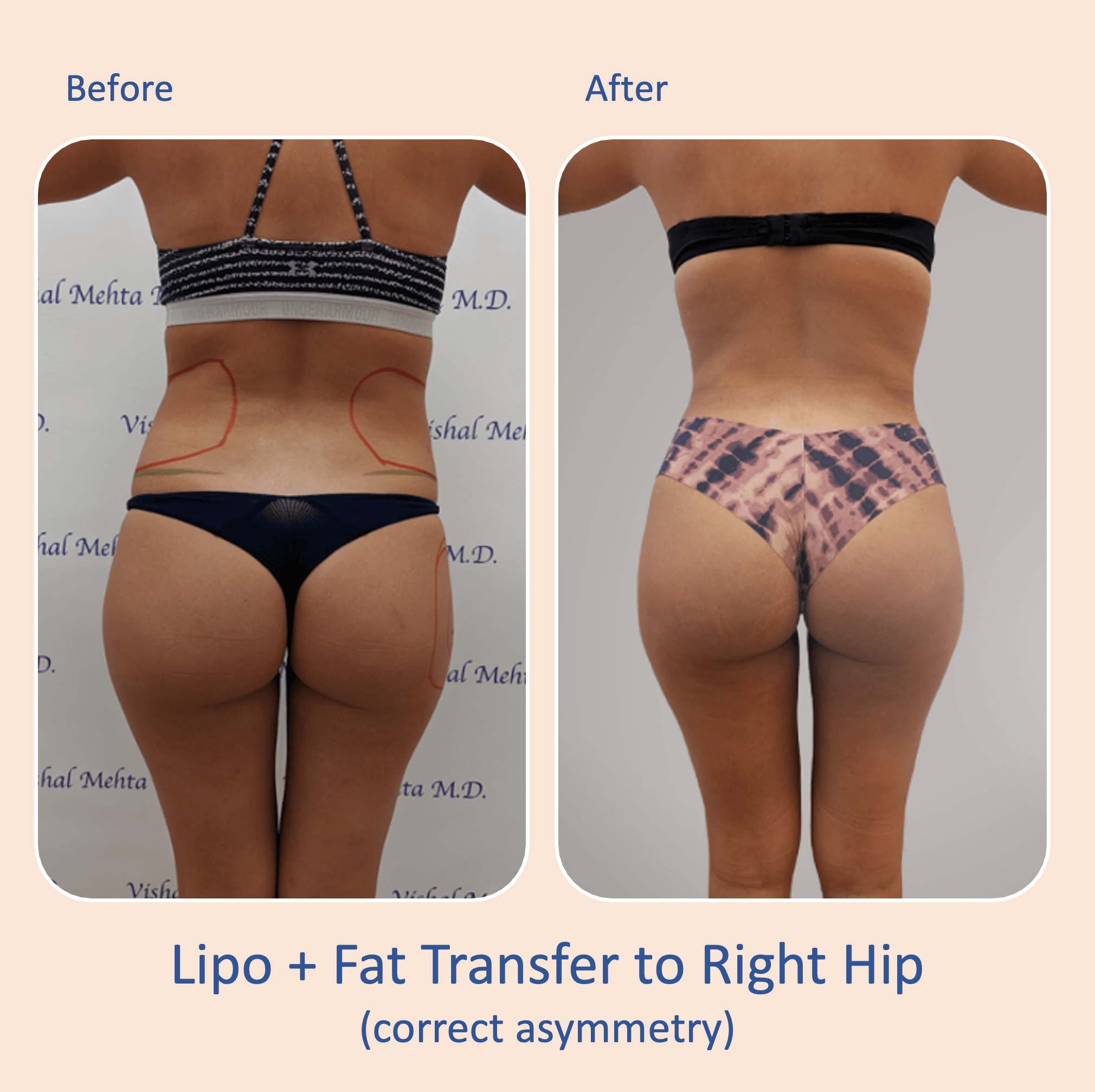 Before & after results of awake liposuction, lipo-sculpting and fat transfer performed by Dr. Vishal Mehta, top Liposuction Surgeon, Central NJ