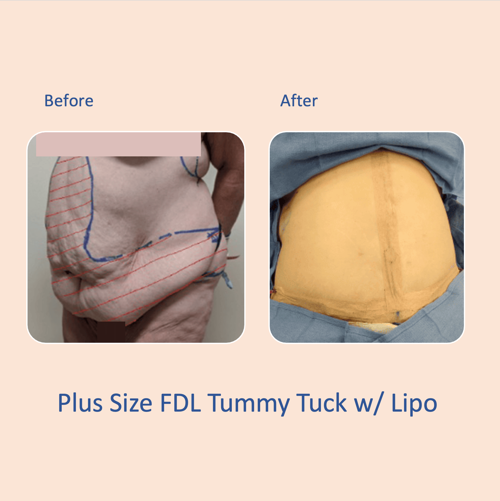 Before & after results of Fleur-de-Lis, FDL tummy tuck and liposuction, lipo-sculpting performed by Dr. Vishal Mehta, top Liposuction & Tummy Tuck Surgeon, Central NJ
