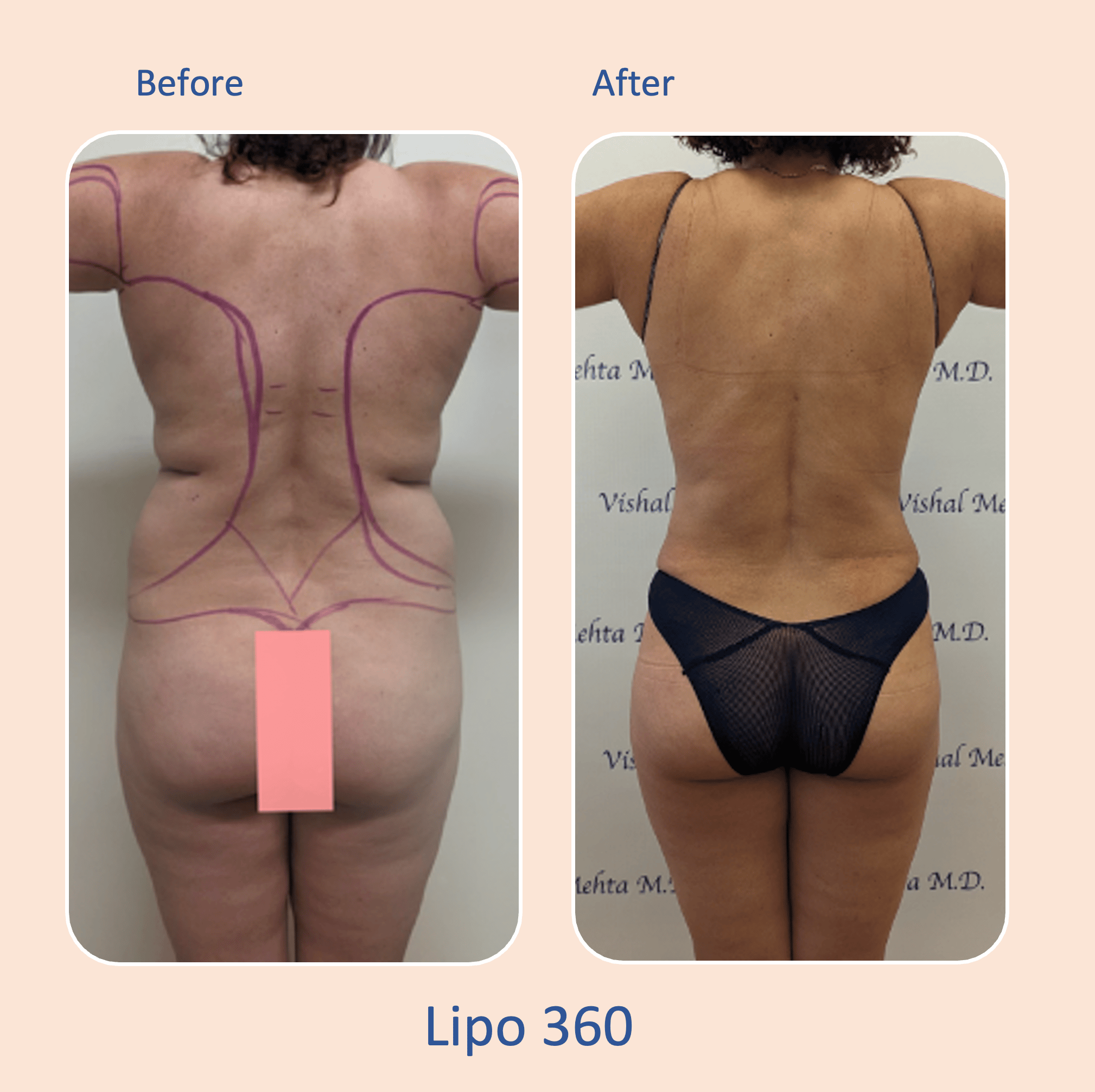 Before & after results of awake liposuction, lipo-sculpting performed by Dr. Vishal Mehta, top Liposuction Surgeon, Central NJ