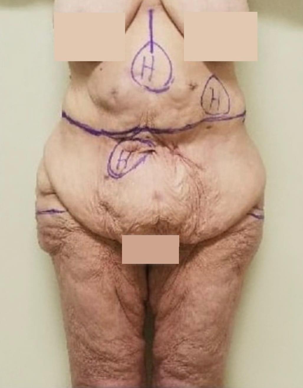 Before & after results of abdominoplasty, tummy tuck, panniculectomy performed by Dr. Vishal Mehta, top bariatric Surgeon serving Central NJ, Princeton, Montgomery, and surrounding areas.
