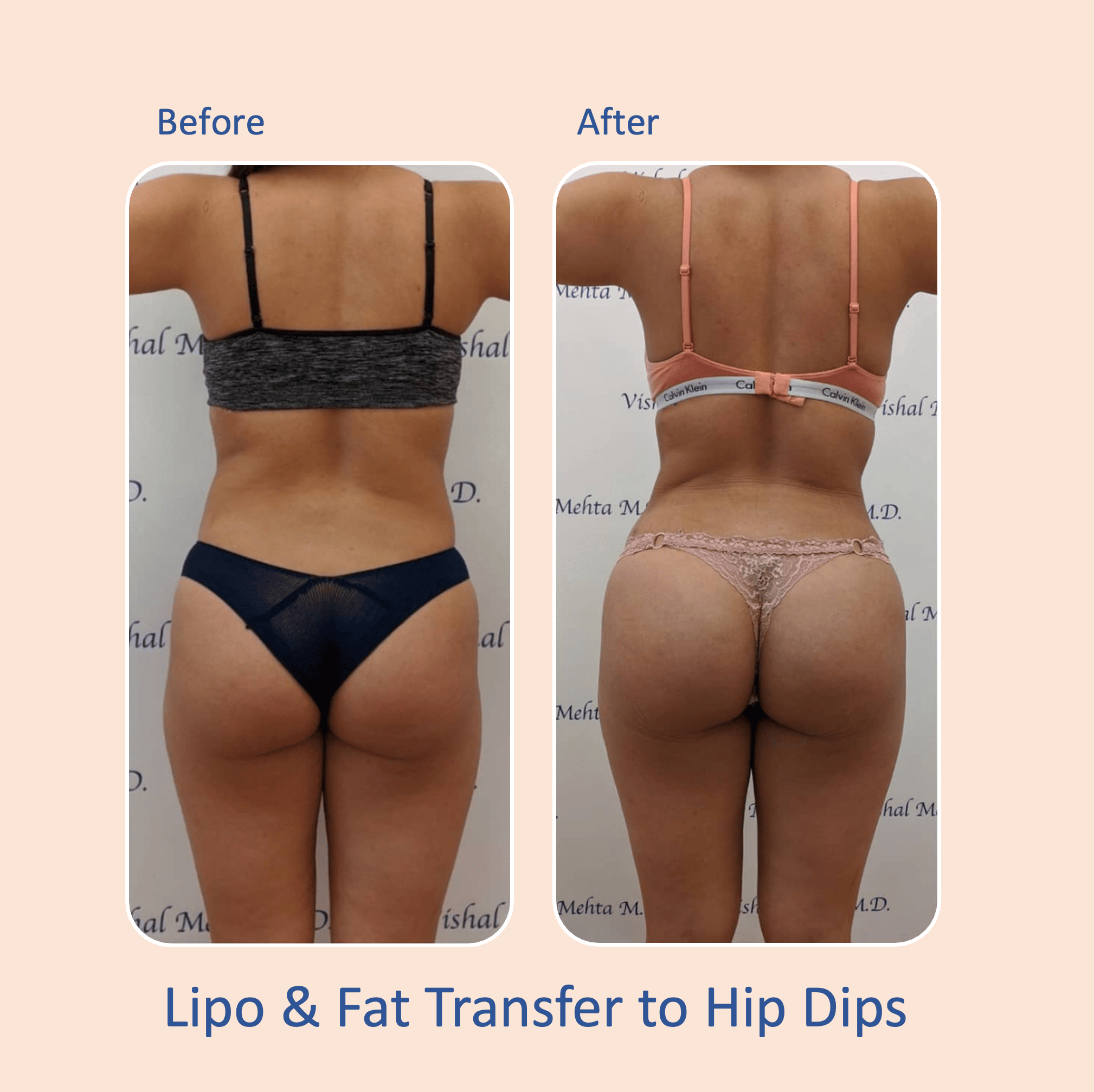 Before & after results of awake liposuction, lipo-sculpting and fat transfer to buttocks, Brazilian Butt Lift, BBL performed by top Liposuction Surgeon, Central NJ