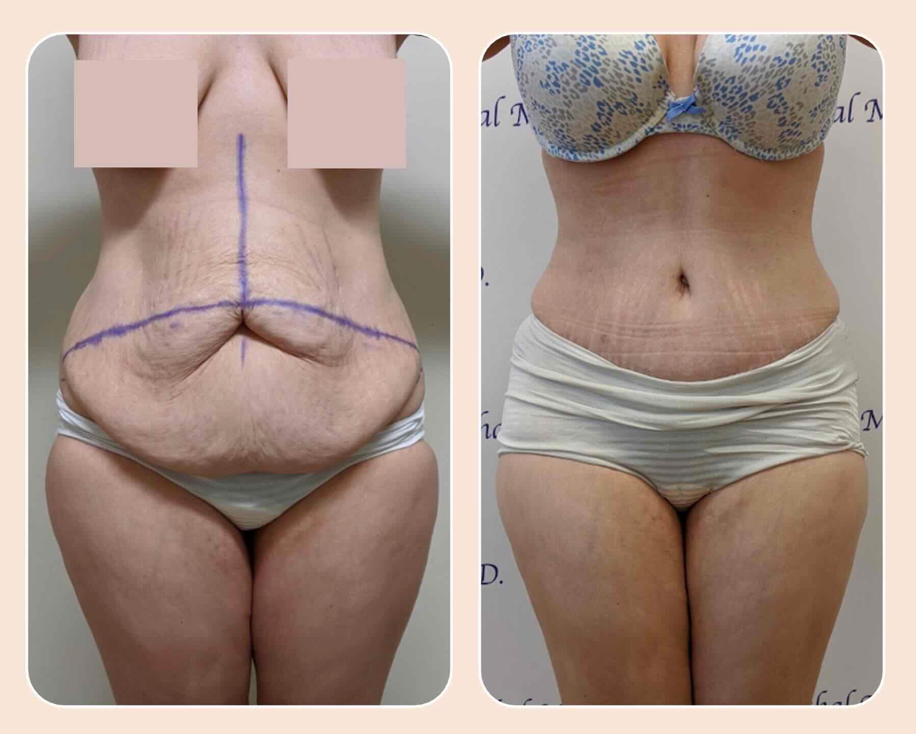Before & after results of tummy tuck and liposuction, lipo-sculpting performed by Dr. Vishal Mehta, top Liposuction Surgeon serving Central NJ, Princeton, Montgomery, NJ and surrounding areas.