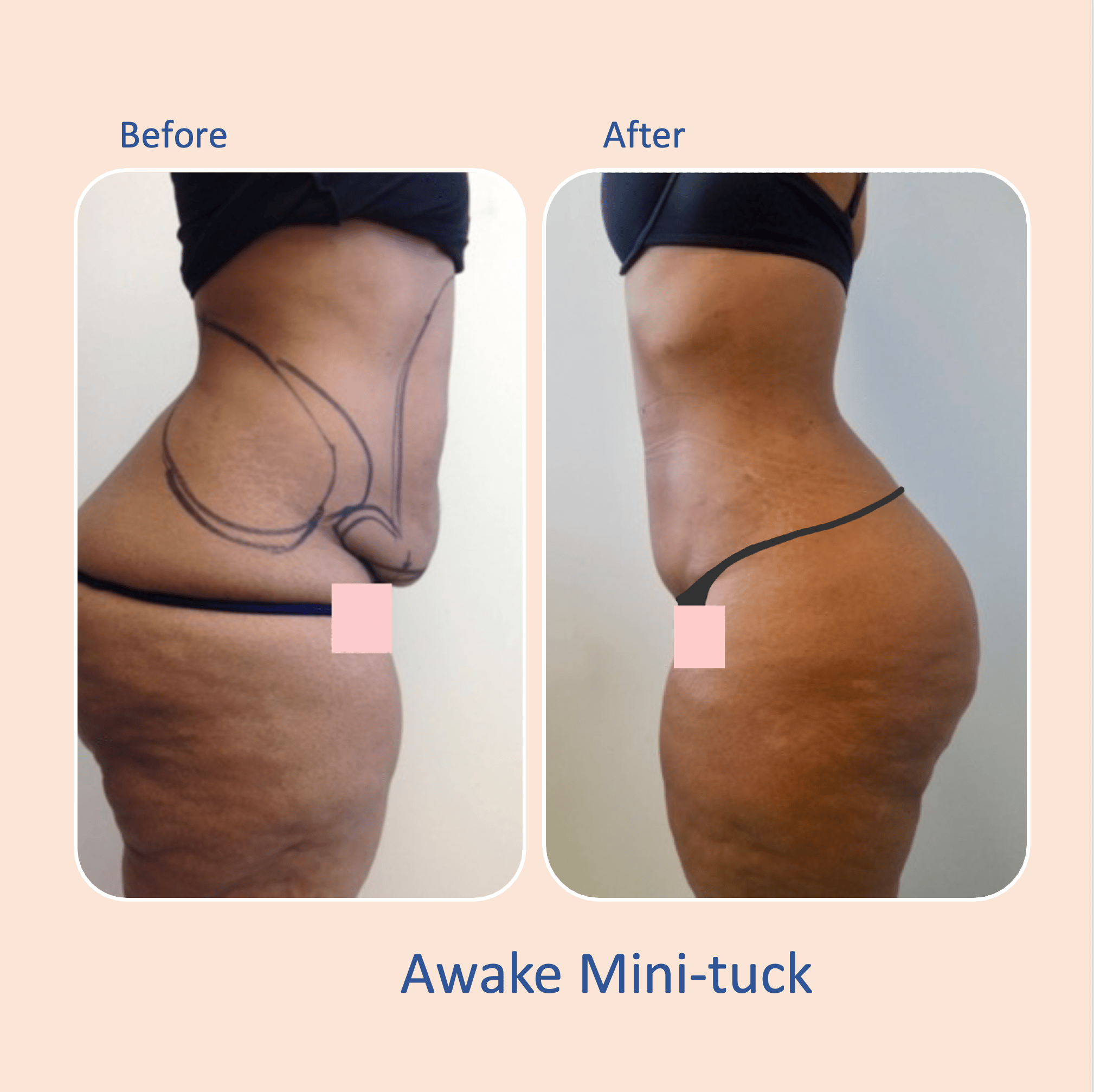 Before & after results of awake mini-tummy tuck and liposuction, lipo-sculpting performed by Dr. Vishal Mehta, top Liposuction Surgeon, Central NJ
