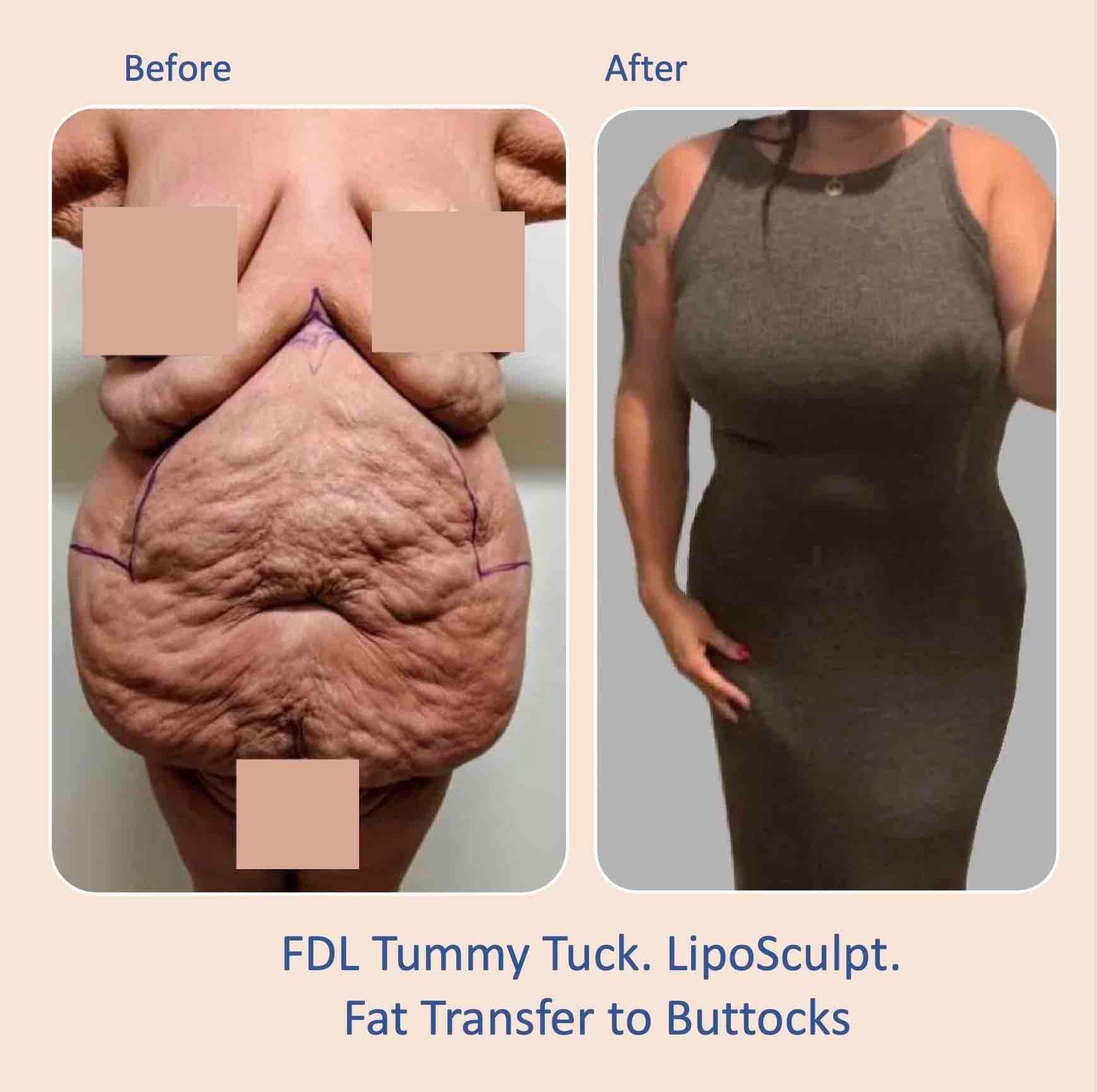Before & after results of Fleur-de-Lis, FDL tummy tuck and liposuction, lipo-sculpting performed by Dr. Vishal Mehta, top Liposuction & Tummy Tuck Surgeon, Central NJ