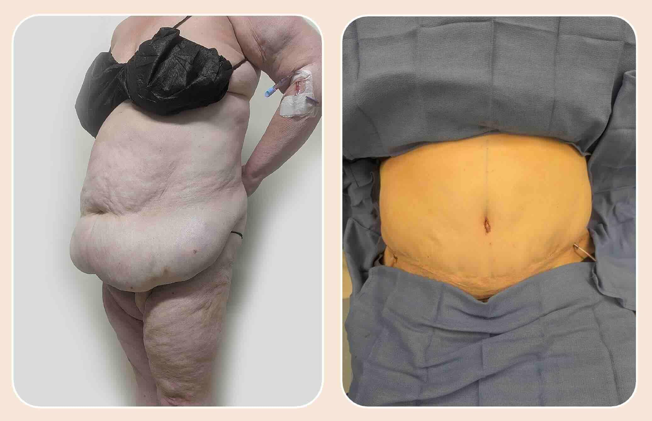 Before & after results of male, men, abdominoplasty, tummy tuck, panniculectomy performed by Dr. Vishal Mehta, top bariatric Surgeon serving Central NJ, Princeton, Montgomery, and surrounding areas.
