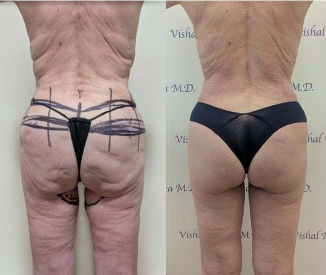 Before & after results of awake liposuction, lipo-sculpting performed by Dr. Vishal Mehta, top Liposuction Surgeon, Central NJ