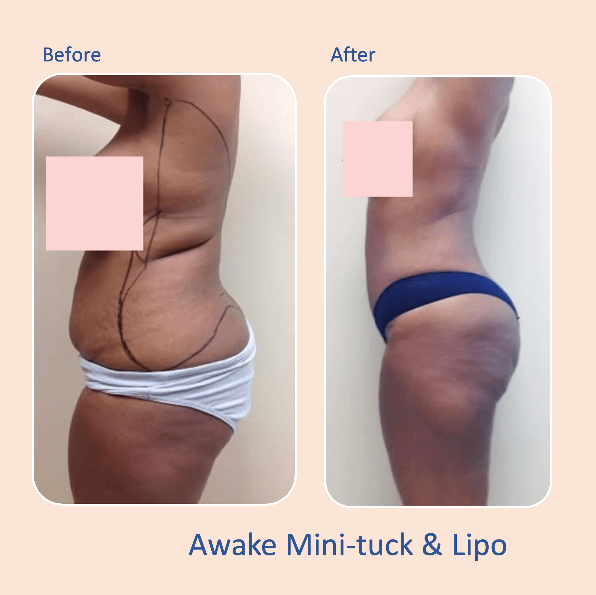 Before & after results of awake mini-tummy tuck and liposuction, lipo-sculpting performed by Dr. Vishal Mehta, top Liposuction Surgeon, Central NJ