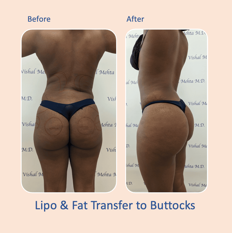 Before & after results of awake liposuction, lipo-sculpting and fat transfer to buttocks, Brazilian Butt Lift, BBL performed by top Liposuction Surgeon, Central NJ