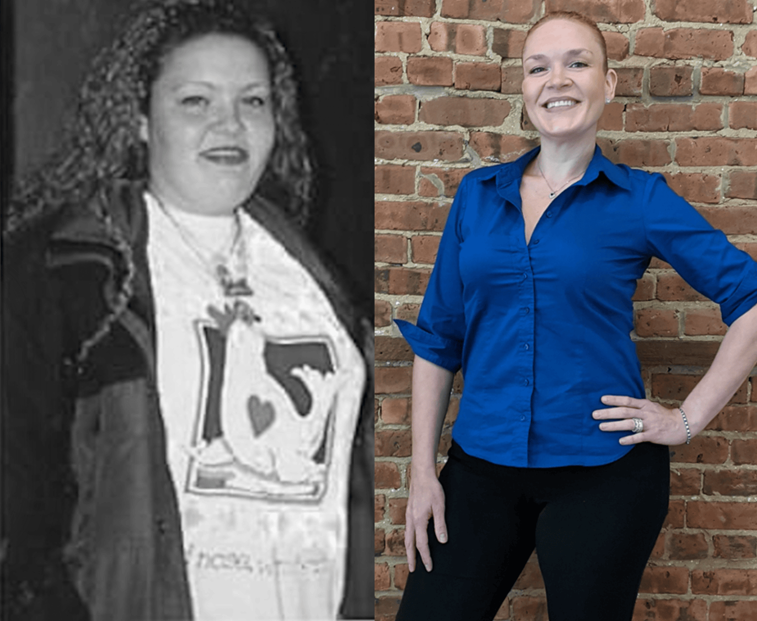 Before & after results of bariatric surgery, gastric sleeve, weight loss surgery, performed by Dr. Vishal Mehta, top bariatric Surgeon serving Central NJ, Princeton, Montgomery, and surrounding areas.