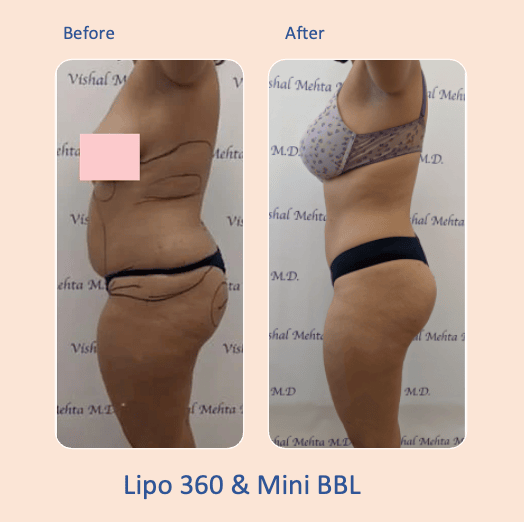 Before & after results of awake liposuction, lipo-sculpting performed by Dr. Vishal Mehta, top Liposuction Surgeon, Central NJ