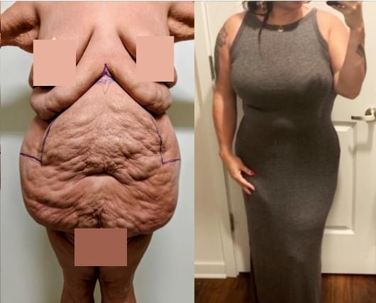 Before & after results of awake liposuction, lipo-sculpting performed by Dr. Vishal Mehta, top Liposuction Surgeon, Central NJ