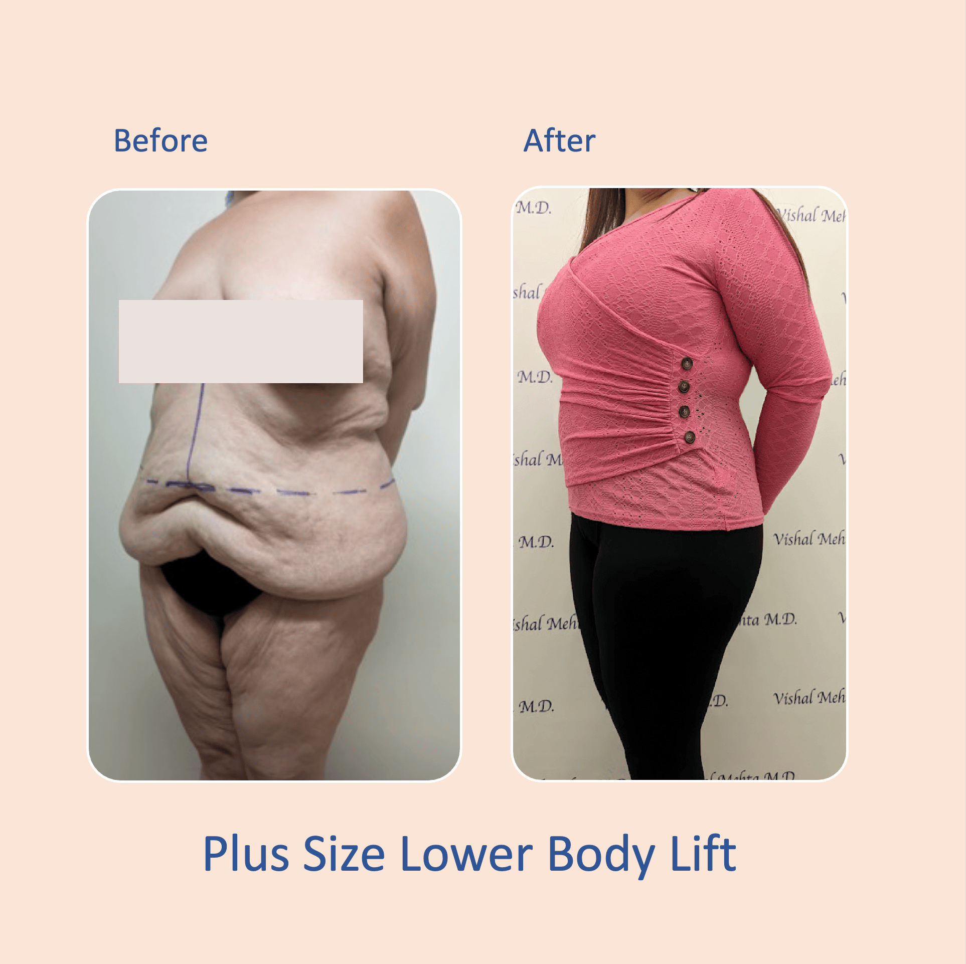 Before & after results of awake liposuction, lipo-sculpting performed by Dr. Vishal Mehta, top Liposuction Surgeon, Central NJ