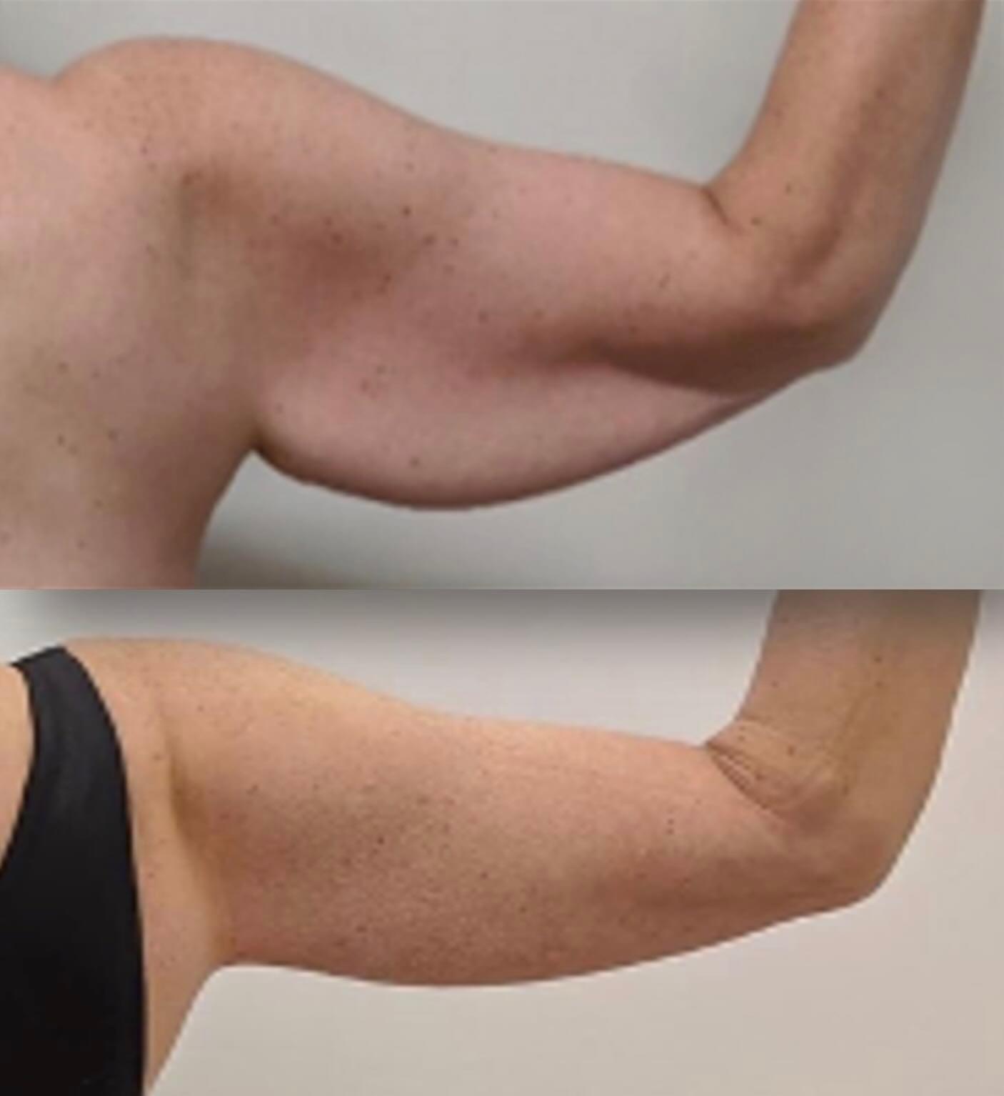 Before & after results of bariatric surgery, gastric sleeve, weight loss surgery, performed by Dr. Vishal Mehta, top bariatric Surgeon serving Central NJ, Princeton, Montgomery, and surrounding areas.