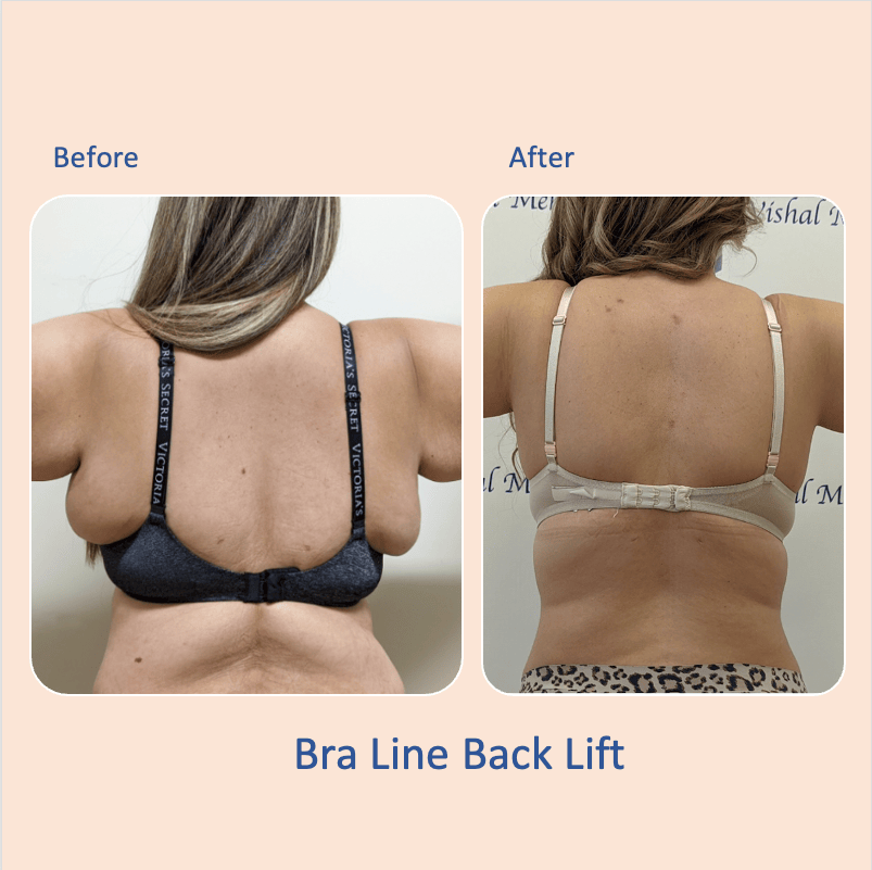 Before & after results of bra-line back lift, performed by Dr. Vishal Mehta, top Surgeon serving Central NJ, Princeton, Montgomery, and surrounding areas.